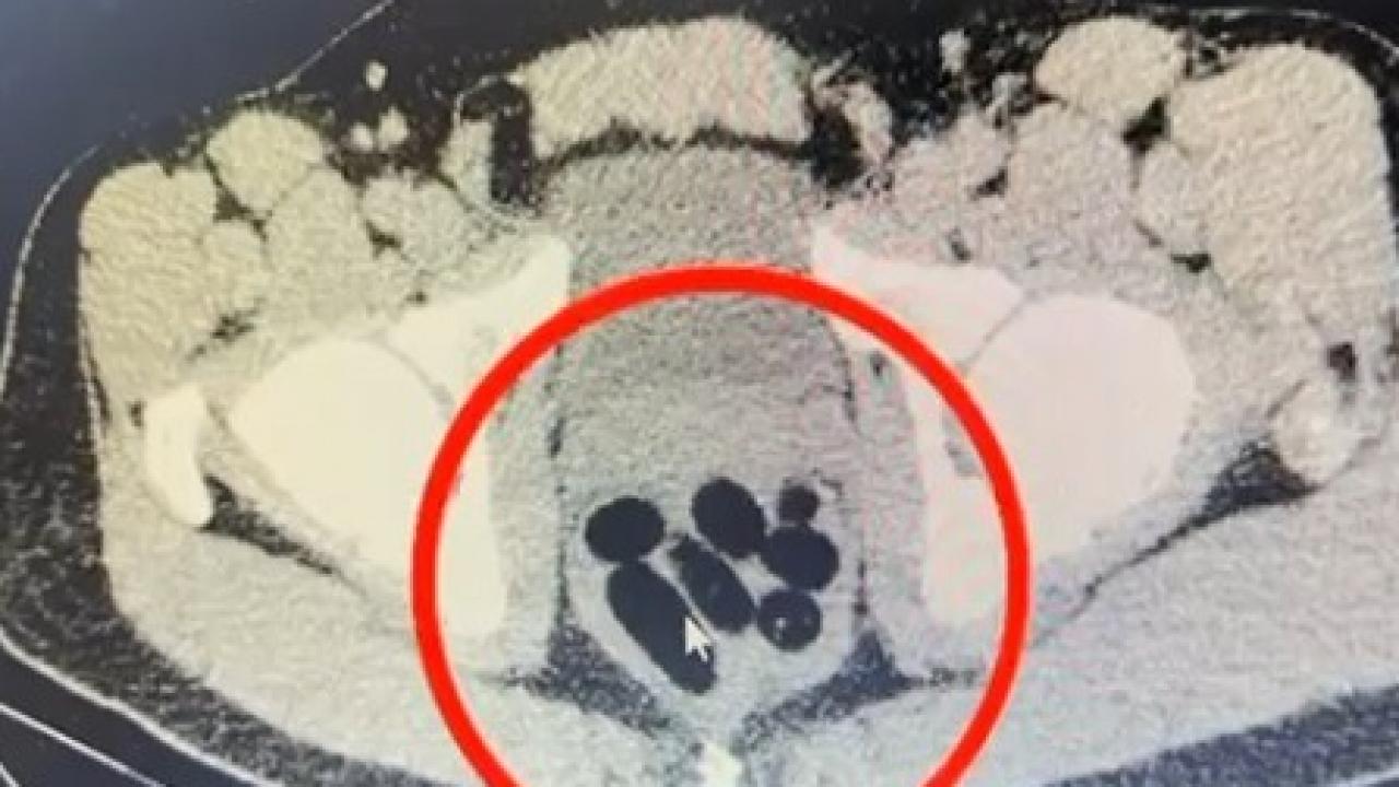 Kayseri’de uyuşturucu operasyonu: Midesinden çıkan şoke etti